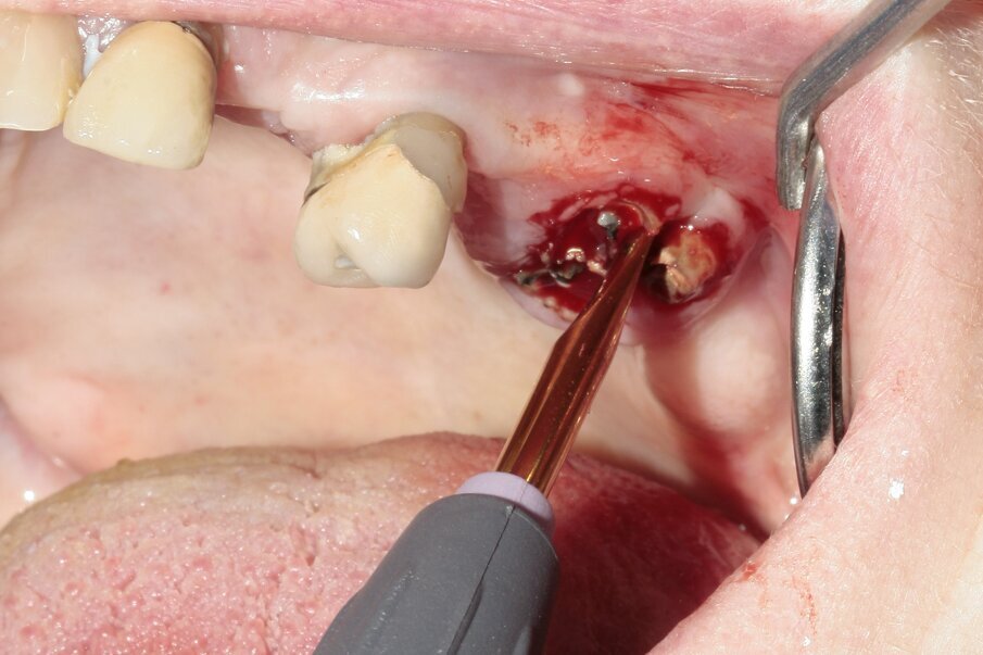 Fig. 5: Luxation of the mesiobuccal root.