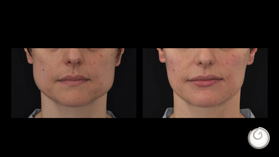 Prima e dopo il trattamento