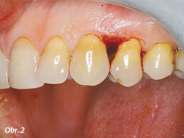 K odstranění hyperplastické tkáně byl použit diodový laser, a to během několika málo minut a bez krvácení.