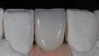 Zimmer: Γωνιώδη κολοβώματα ζιρκονίου παρέχουν μία εξυπηρετική αισθητική λύση