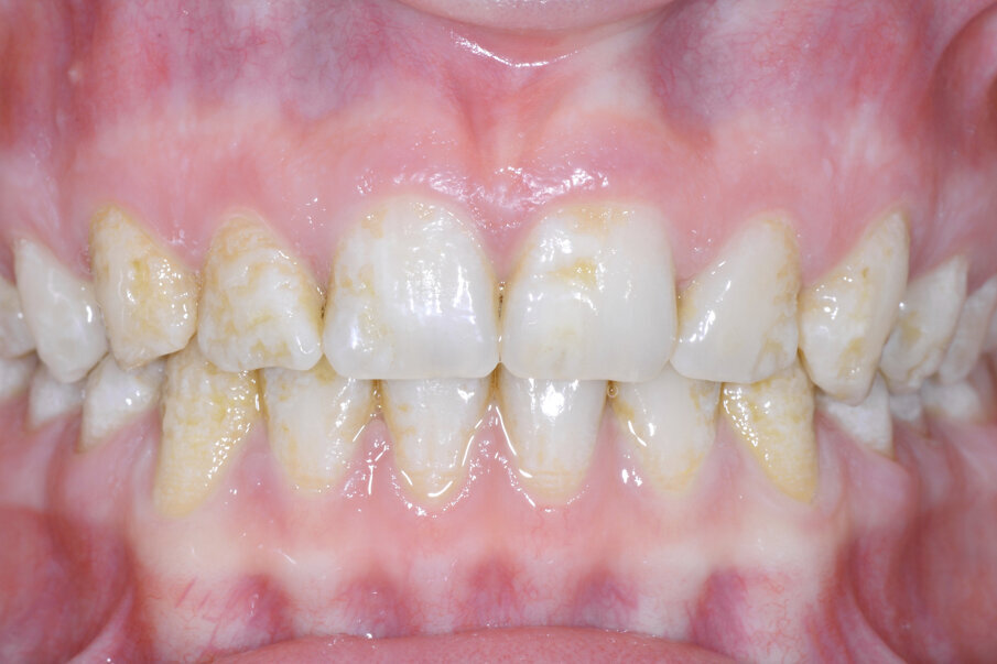Figs. 13: Restoration in amelogenesis with classical COMPONEER
