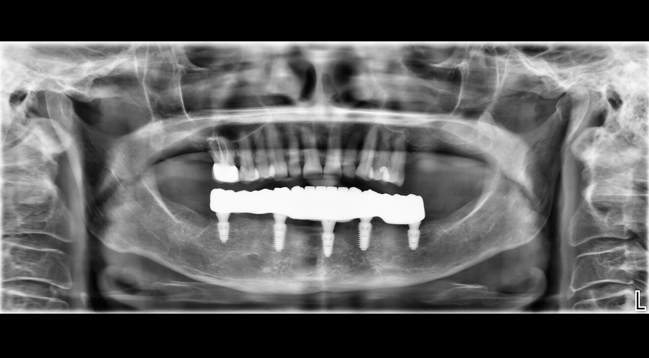 Fig. 16d: Final panoramic radiograph.