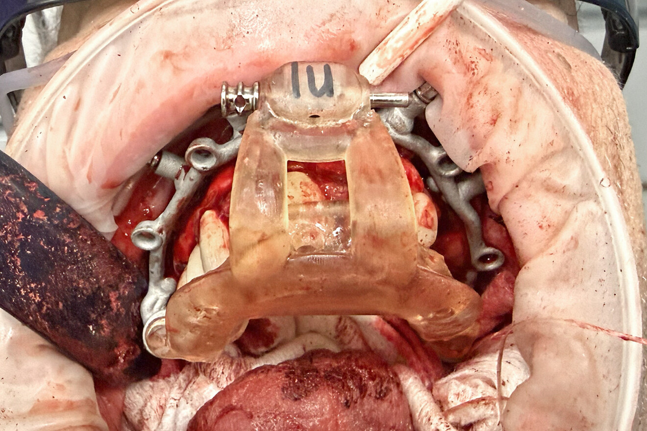 Fig. 16: Retracted intra-oral view of the surgical site with the positioning guide placed over the remaining teeth and the base frame attached. 