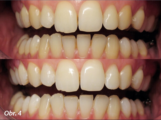 Obr. 4: Situace před a po ordinačním bělení u pacientky s lingválním aparátem.