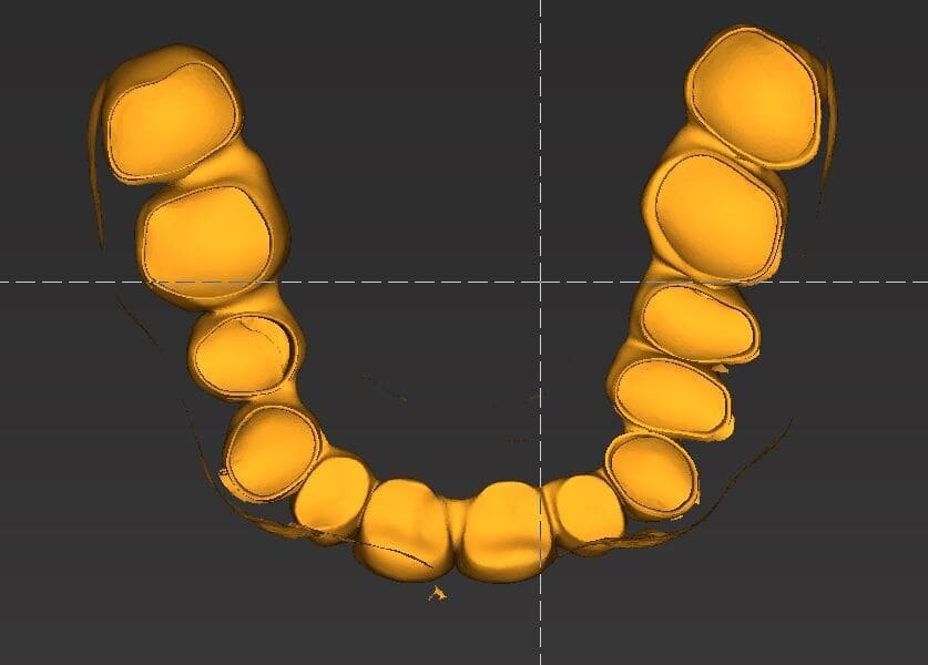 Fig. 6_Visione interna del provvisorio eseguito dal wax-up in prematura.