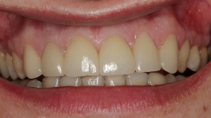 Przywrócenie estetyki uśmiechu w odcinku przednim szczęki przy pomocy technologii CAD/CAM