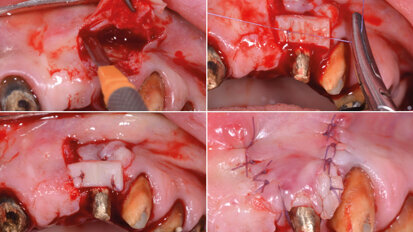 Riabilitazione totale di tipo estetico-funzionale con terapia parodontale, implantare, protesica, mucogengivale e gnatologica