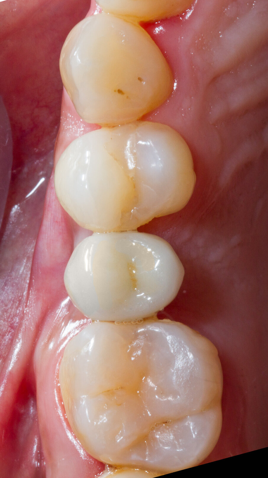 Fig. 28 - Corona protesica cementata; vista occlusale.
