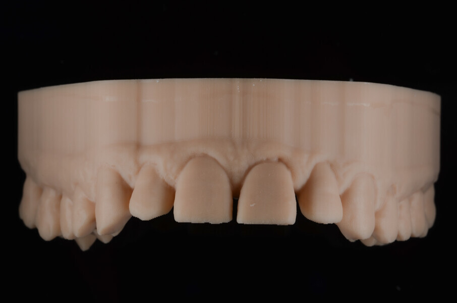 Fig. 4a: Initial models 3D-printed from Asiga DentaMODEL using the MAX UV, anterior view. 