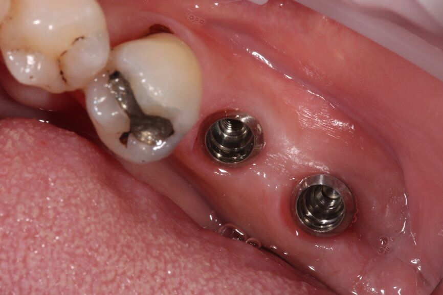 Fig. 11: Tissue level implants.