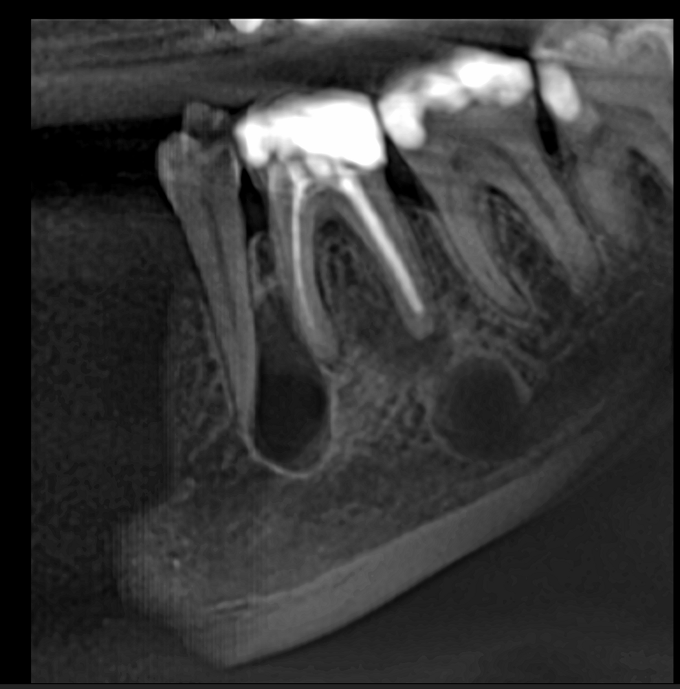 Fig. 1: 2D image generated from the DEXIS OP 3D scan, showing multiple bone lesions.