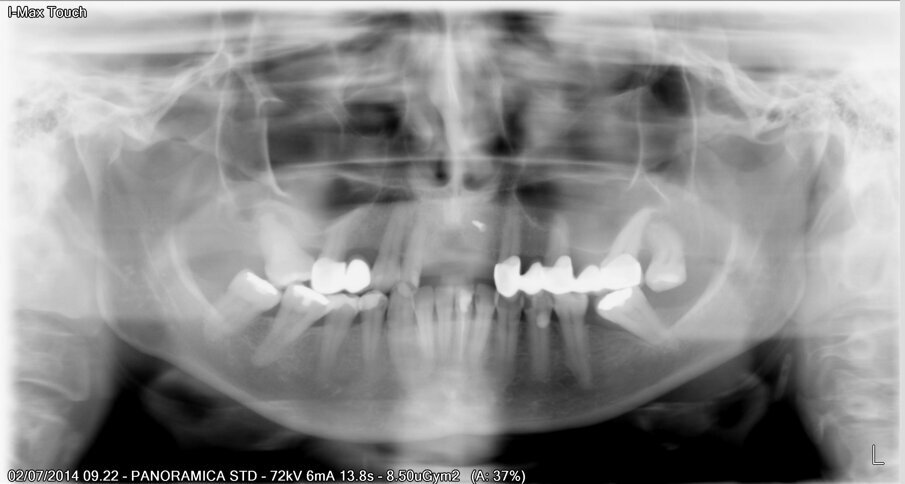 Fig. 13 - Valutazione del sito rigenerato all’esame radiologico.