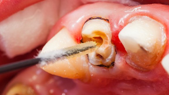 ובינר בנושא איטום תעלות שורש בתלת מימד