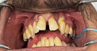 AI-facilitated bone segmentation for the fabrication of bone-borne surgical guides