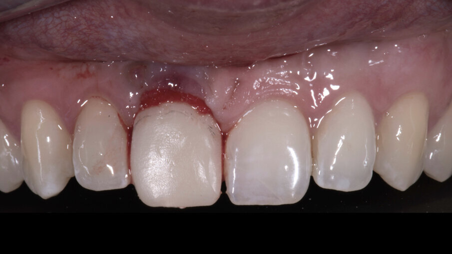 Fig. 27_Il provvisorio nella seduta chirurgica viene avvitato immediatamente all’impianto.