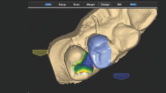 E4D chairside CAD/CAM restorations: Case presentations and lessons learned
