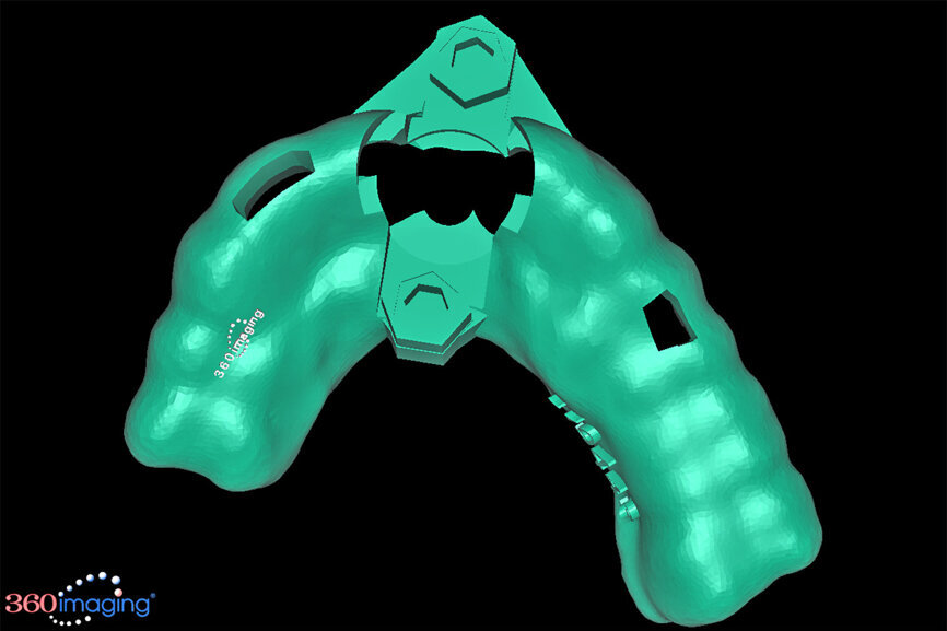 Fig. 15a: The base template was designed to seat firmly on the adjacent teeth, incorporating buccal and lingual hexagonal offsets to engage the different drill
guide inserts.