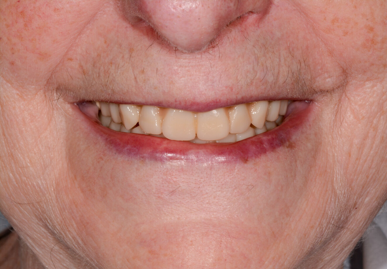 Fig. 12: 3D-printed dentures in situ after two weeks of wear, frontal view.