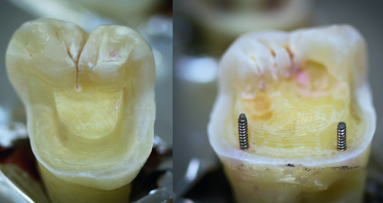 Exploring the fracture resistance of retentive pin-retained e.max press onlays in molars