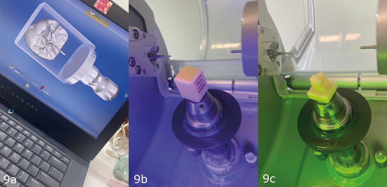 Figs. 9a–c: Creation of the CAD for the endocrown (a). Grandio blocs A3 LT block ready for milling (b). Endocrown milled from Grandio blocs (c).