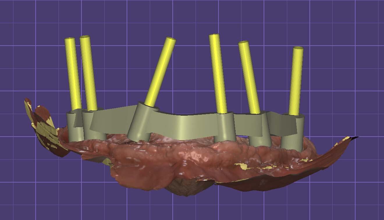 Fig. 2: Design of the passive bar on the implants.