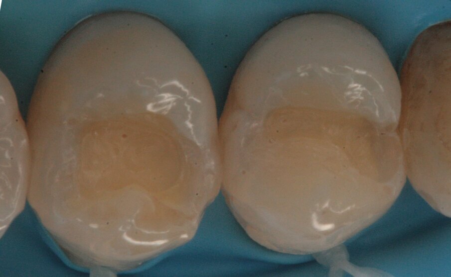 Figg. 15, 16_Preparazione delle cavità.