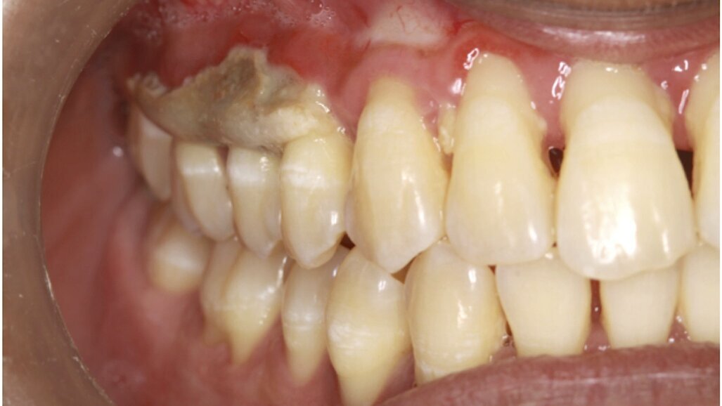 Osteonecrosis maxilar por medicamentos no bifosfonatos