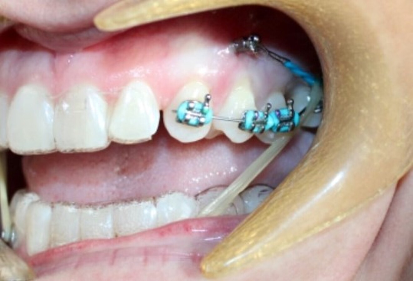 Fig. 11: The set-up with sectional brackets and a temporary anchorage device.