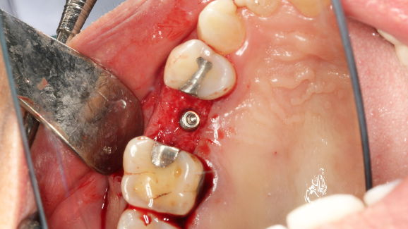 Синтетична мембрана може да ускори оздравяването при имплантиране