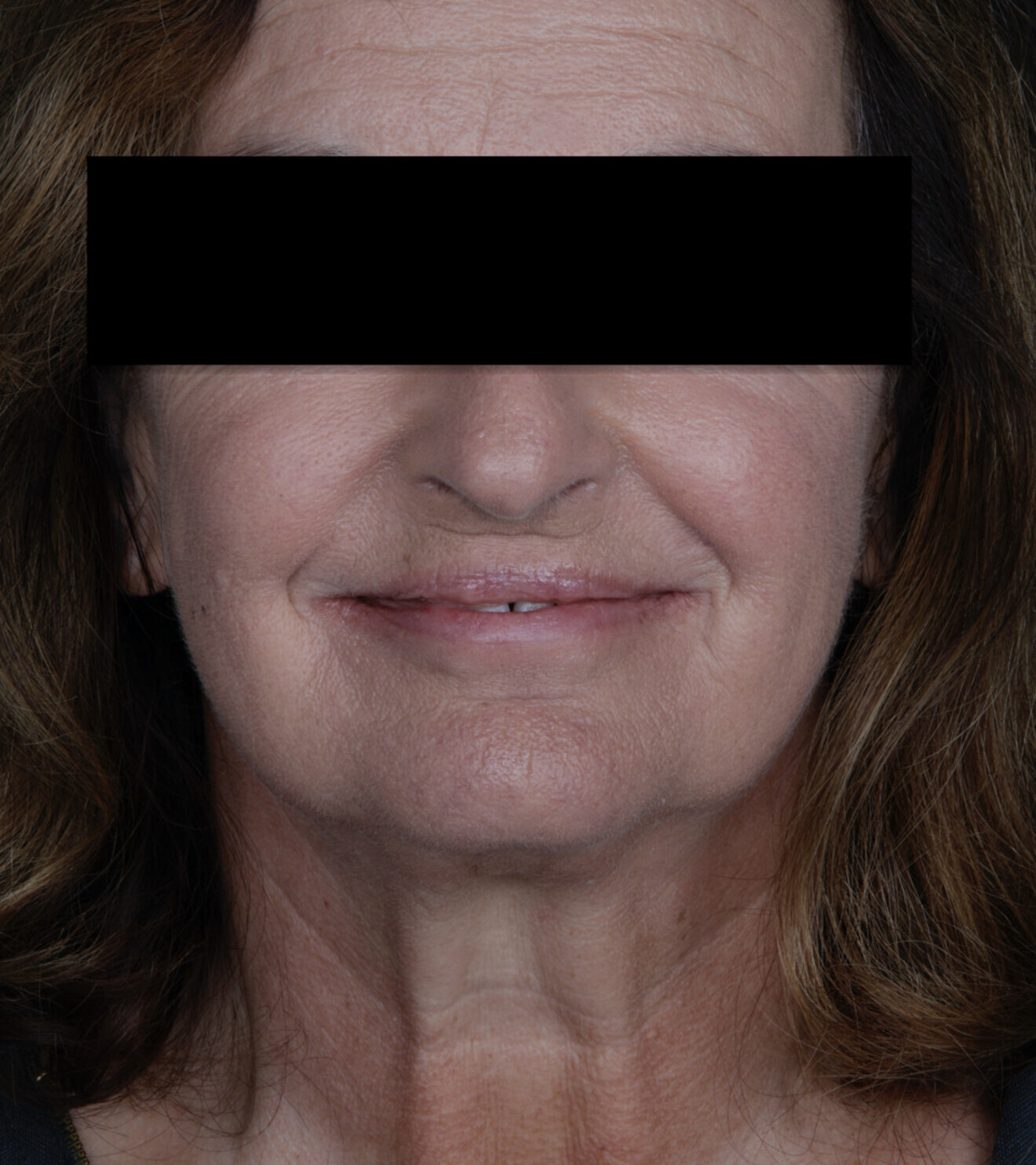 Figs. 1–3: The initial situation showed significant spacing between the teeth