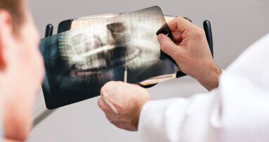 Pesquisadores da Charité estudam detecção confiável e tratamento da cárie