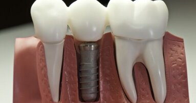 Kostenbesparing en toenemende toegang tot orale implantaten