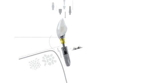 Dentsply Sirona – XiVE