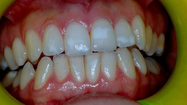 Manifestazioni orali nel paziente celiaco