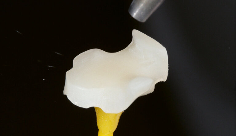 Fig. 7: Air-blasting the bonding surface wit 50 – 100 μm aluminium oxide at 1 – 1.5 bar; followed by cleaning
