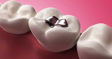 Pläne der EU-Kommission zum Amalgamverbot