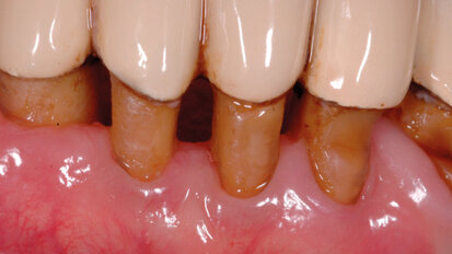 Ruolo delle nicchie ecologiche nell’eziologia dell’alitosi: la lingua tra le principali cause