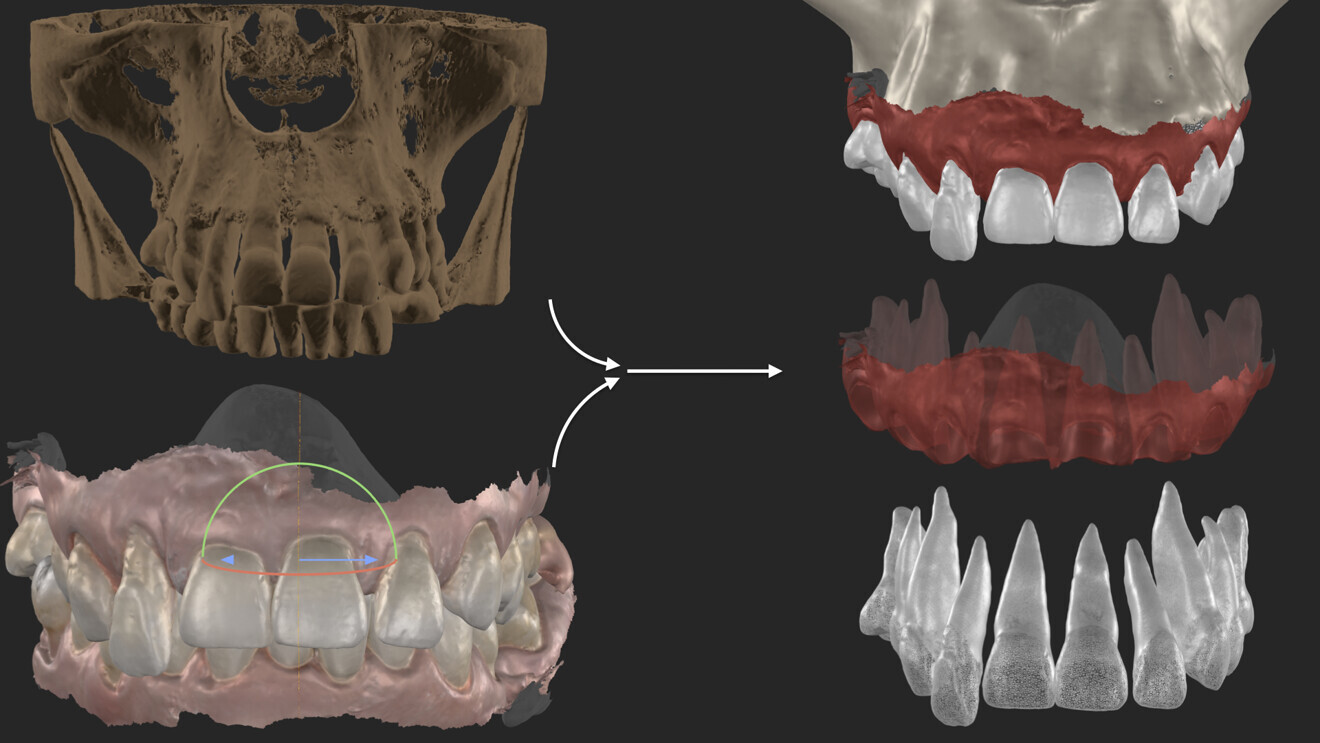 Fig. 6: Combination of the CBCT and the intra-oral scans for segmentation.