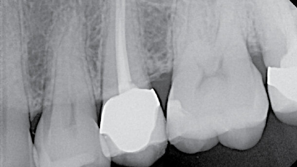 Problematika kalcifikovaných kanálků, kazuistika