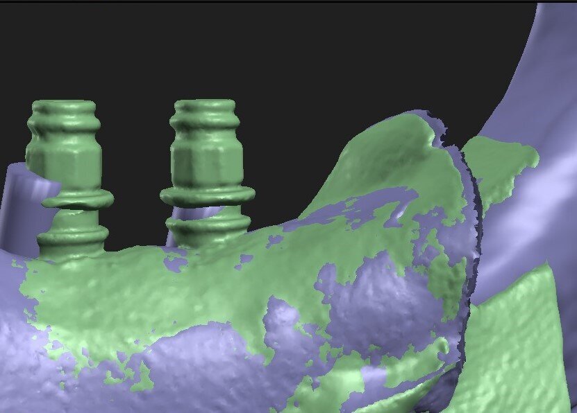 Fig. 7: Implants FH01rm and FH01rd, lingual view. The figure shows two superimposed models. The green model is one with implants and the purple model one with inserts. It can be easily observed that, despite the small spatial displacement of the implant relative to the insert, their axes are convergent.