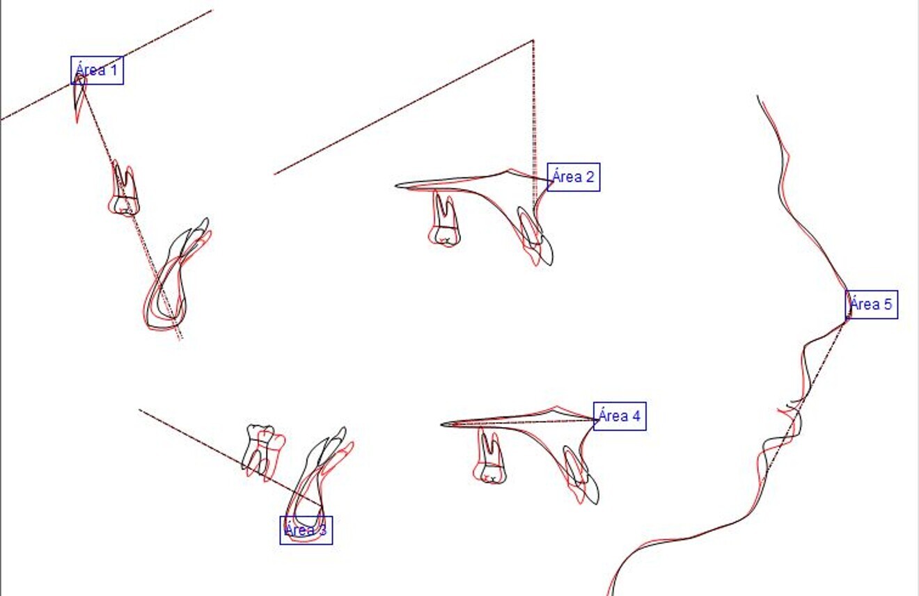 Fig. 24: Superimposed tracings, black corresponding to the pretreatment tracing and red to the post-treatment tracing.