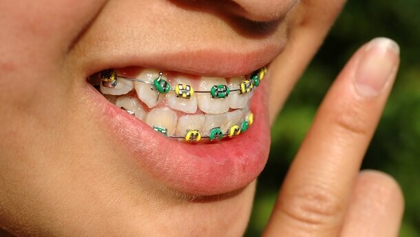 Orthodontisten schroeven tarieven op