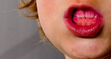 Grafeno reduz cárie e doença periodontal