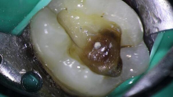 Diagnosis and management of a longitudinal fracture necrosis associated with an extensive periodontal defect