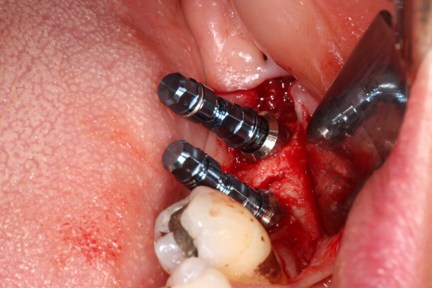 Fig. 9: Surgical placement of LL67 implants.