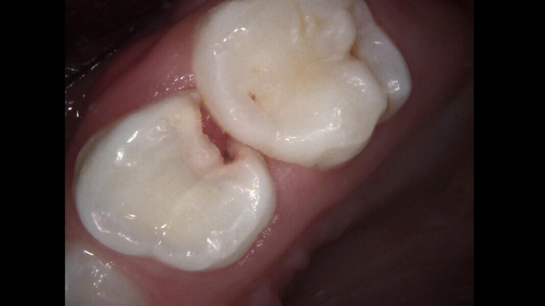 Fig. 19: Initial condition. Interproximal decay.