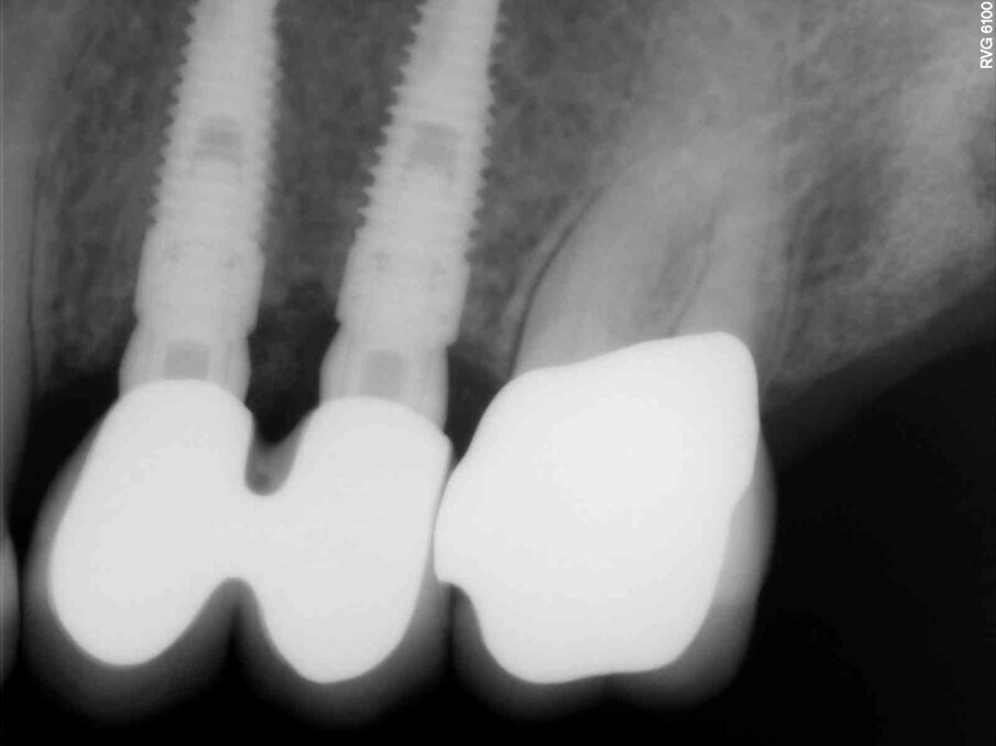 Fig. 6c_Controllo rx a 2 anni dal posizionamento implantare.