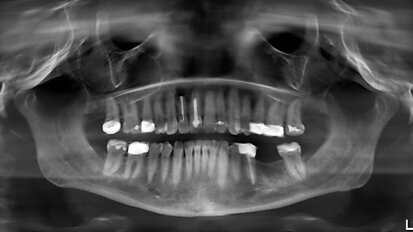 Un concept prothétique implanto-porté d’avant-garde pour une réussite et une stabilité tissulaire à long terme