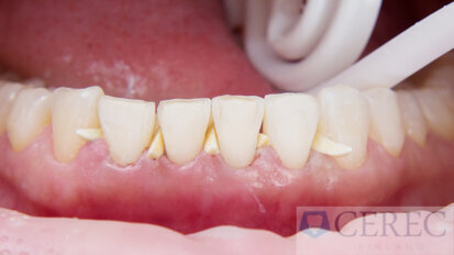 Kombinace CAD/CAM – assisted treatment pro nový krásný úsměv