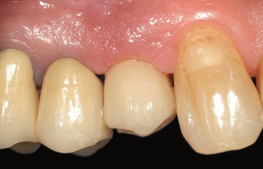 Fig. 2b_Fase protesica provvisoria. Corona provvisoria avvitata.
